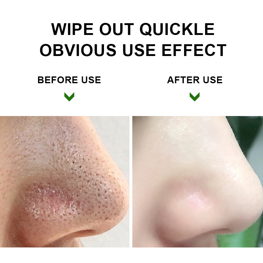 Perfectcare Tea Tree Oil Blackhead Removing Kit